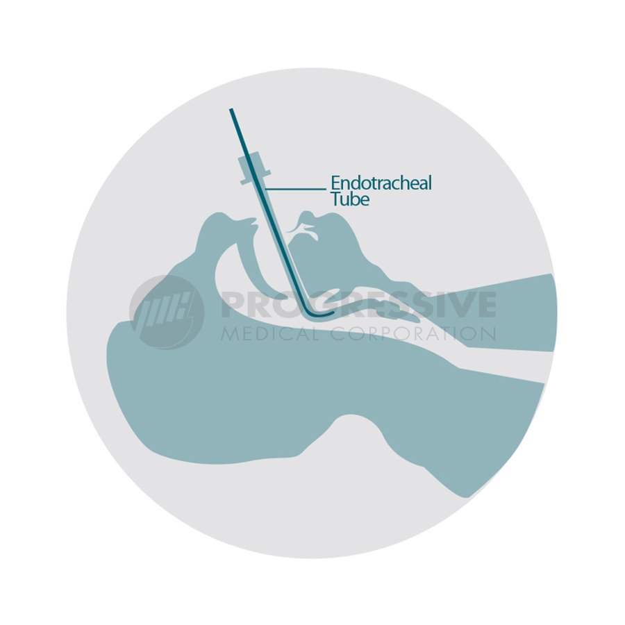 Sedasenz Intubating Stylet (2)
